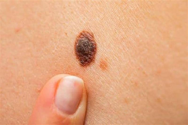 Skin Cancer: Beware of Falling for 