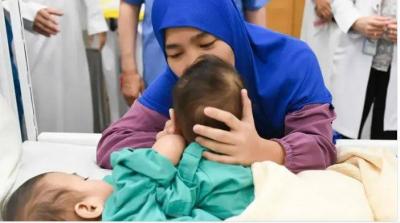 Successful Separation of Filipino Conjoined Twins after 7 Hours