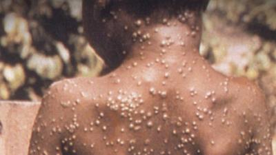 WHO Holds Emergency Meeting Due to "Monkeypox"