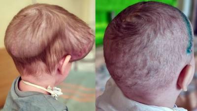 Successful Surgery to Remove Major Deformity from a Girl's Head