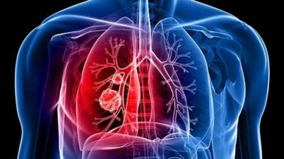 Simple Test Reveals Lung Cancer Risk