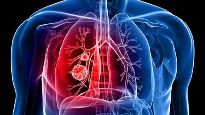 Simple Test Reveals Lung Cancer Risk