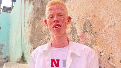 The Suffering of People with Albinism: "We Are Not Cannibals"