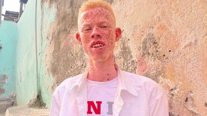 The Suffering of People with Albinism: 