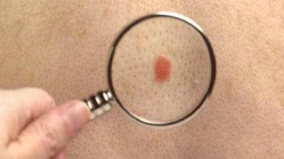 New Vaccine Destroys Cancer-Causing Moles