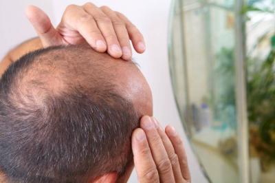 Scientists One Step Closer to Baldness Cure
