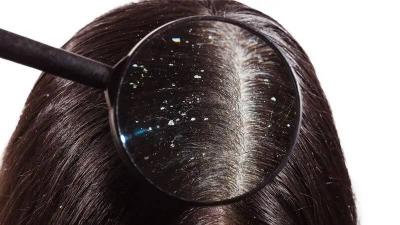 Dandruff: What Are Its Causes?