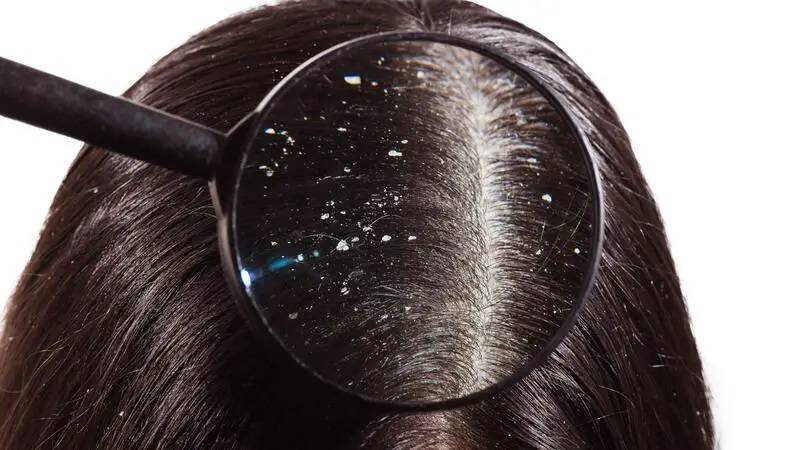 Dandruff: What Are Its Causes?