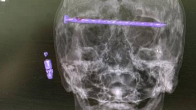 Title: Extraction of a Nail from Man's Head