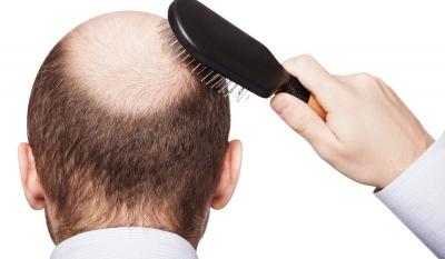 The "Real" Reason for Hair Loss!
