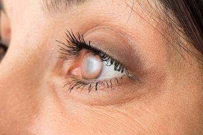 The Ideal Age for Vision Correction Surgery