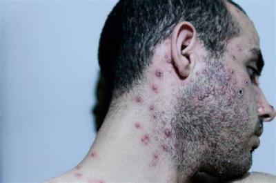 Will Monkeypox Turn into an Epidemic Like COVID-19?