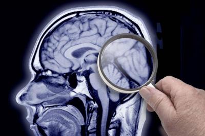Alzheimer's Disease: Just One of Many Types of Dementia, Expert Reveals