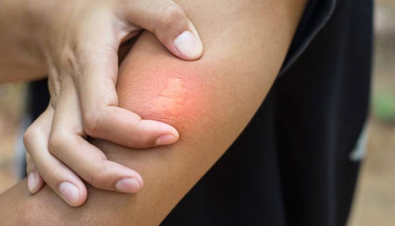 How to Treat a Bee Sting?