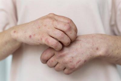 Pakistan Records First Monkeypox Case from Gulf Region