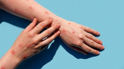 Disappointment with the Monkeypox Drug