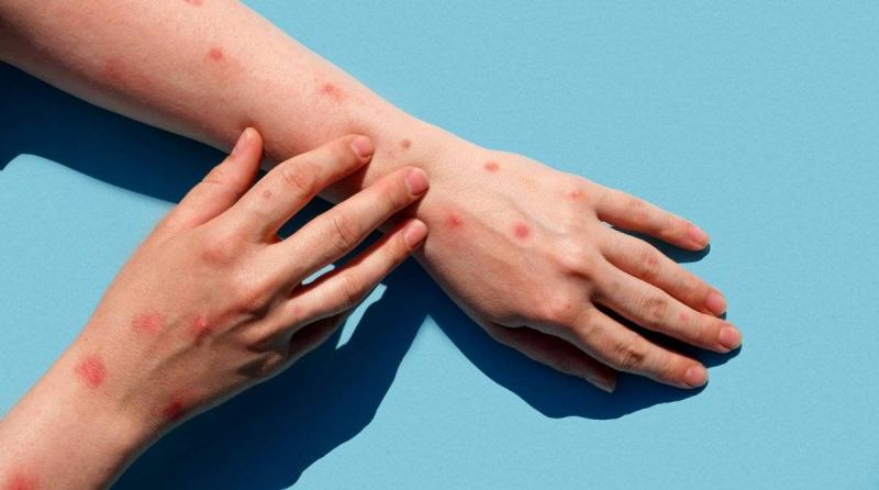 Disappointment with the Monkeypox Drug