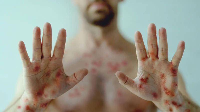 # Monkeypox: What Is It and How Can It Be Prevented?