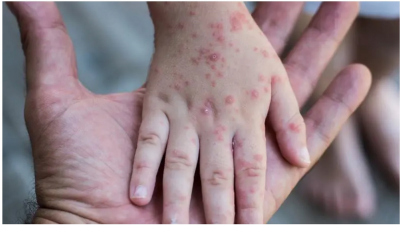 Fear of Monkeypox: Africans Stop Eating Monkey Meat