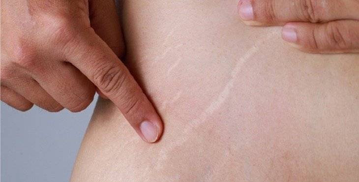 بعض الزيوت تعمل على معالجة مشاكل علامات ترهل الجلد