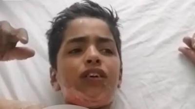 صدمة في الأردن... طلاب مدرسة صبوا الكاز على زميلهم وأحرقوه