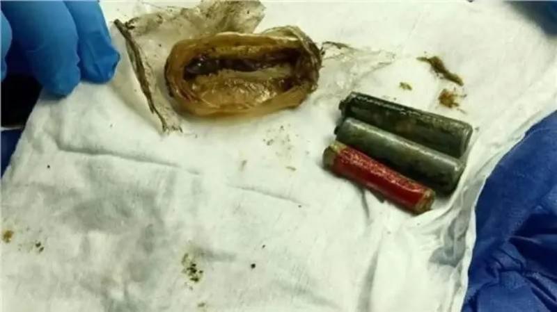 مصر... إخراج 3 بطاريات من معدة مريض