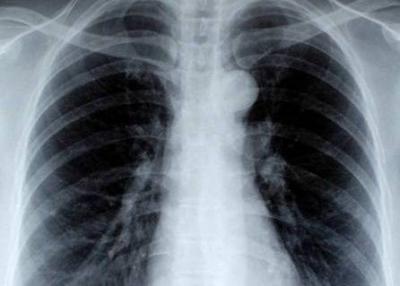 أول لقاح لسرطان الرئة يعيد الأمل لكثيرين