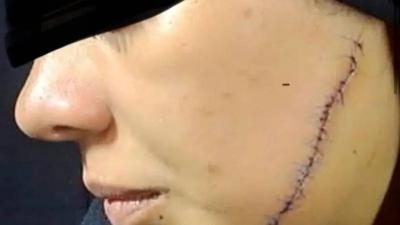 41 غرزة بالوجه.. ضبط سيدة شوهت عروس طليقها قبل أيام من الزفاف