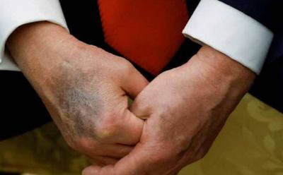 مخاوف صحية حول ترامب بعد ظهور كدمة داكنة جديدة على يده