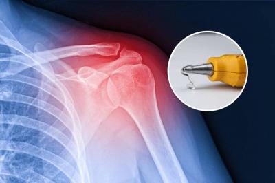 مسدس الغراء لعلاج الكسور.. تقنية ثورية في طب العظام