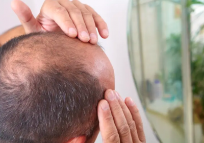 حل سحري للصلع الوراثي للرجال والنساء.. مستخلص من نبات ستيفيا