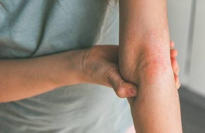 كل ما تحتاج معرفته عن التهاب الجلد الدهني وأفضل طرق الوقاية منه