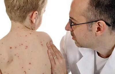 انتشار الجرب في المدارس يستنفر الصحة والتربية الجزائريتين