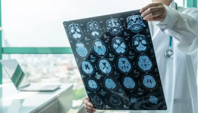 ابتكار ثوري.. قطرات للأنف لعلاج نوع خطير من السرطان