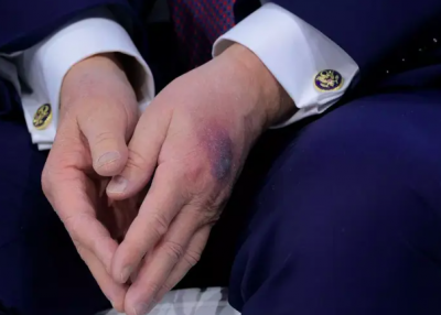 كدمة جديدة على يد ترامب والرئيس يبرر