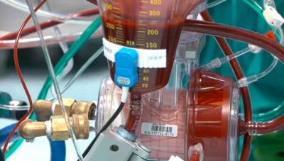 للمرة الأولى.. رئة اصطناعية تُنقذ مريضاً لمدة 48 ساعة