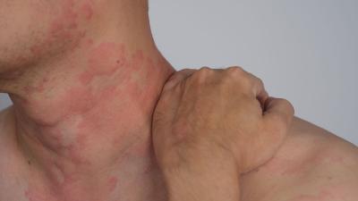 أعراض حساسية الشرى وأسبابها