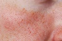 طرق تصغير المسام الواسعة طرق تصغير المسام الواسعة