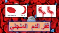 فقر الدم المنجلي فقر الدم المنجلي