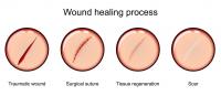 Slow wound healing Slow healing of wounds