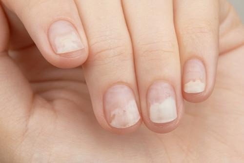 Signs of Vitamin Deficiency Reflected in Your Nails