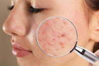 The effects of sleeping with makeup on the skin The harms of sleeping with makeup on the skin.