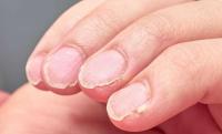 Brittle nails Brittle nails