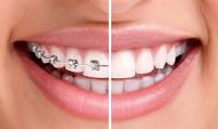 The cost of orthodontics in Lebanon The cost of orthodontics in Lebanon