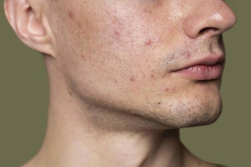 Effective Acne Treatment Methods and Solutions