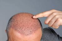 تكلفة زراعة الشعر في لبنان تكلفة زراعة الشعر في لبنان
