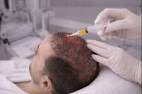 Cost of hair transplant in Lebanon The cost of hair transplant in Lebanon