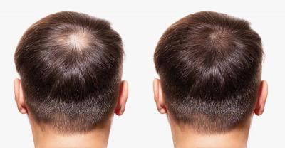 تكلفة زراعة الشعر في لبنان