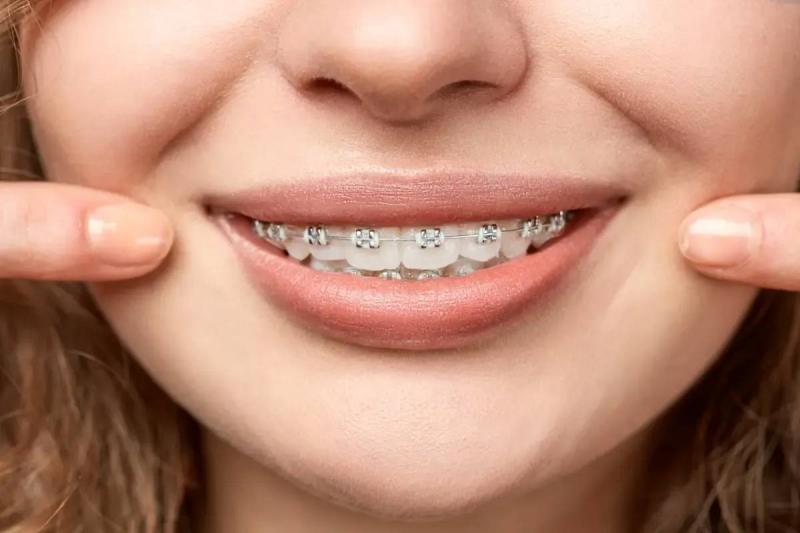 Dental Braces Costs in Lebanon: All You Need to Know