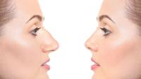 أكثر عمليات التجميل طلبًا في لبنان أكثر عمليات التجميل طلبًا في لبنان